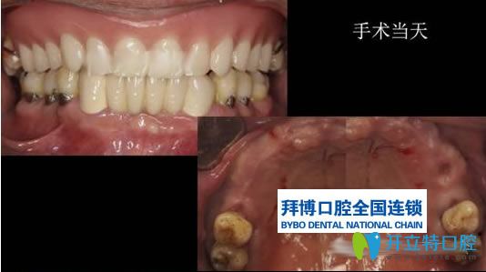 楊小林醫(yī)生無牙頜種植病例前后對比效果