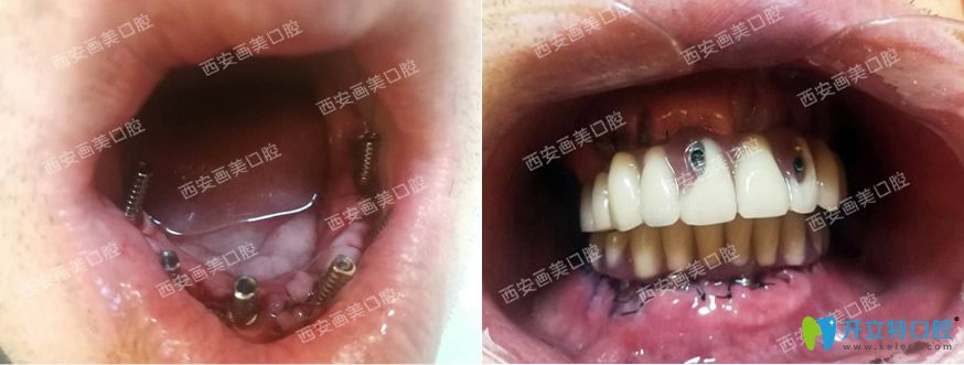 全口種植牙對(duì)比前后