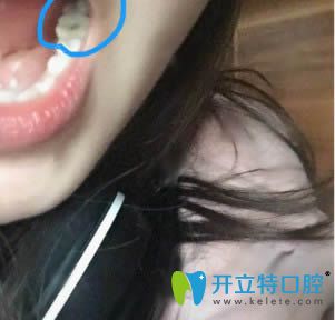 我在泉州維樂(lè)口腔做種植牙后的效果圖
