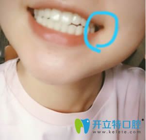 泉州維樂(lè)口腔牙齒種植真人案例效果圖