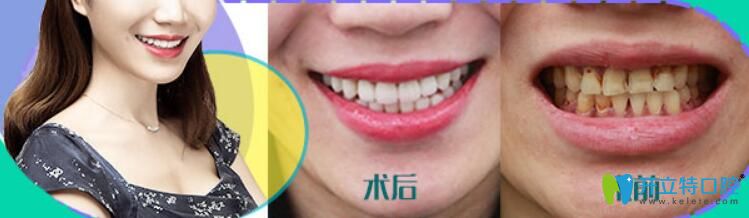 瓷貼面做了后悔死了，后悔沒有早點選擇華美牙科修復我的四環(huán)素牙