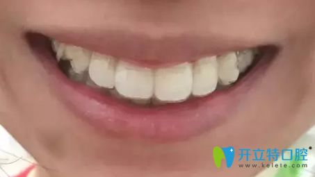 我在北京美萊整形口腔科做牙齒矯正第9個月