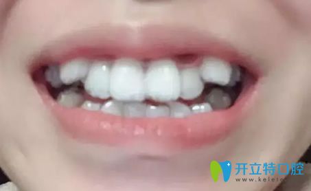 我在北京美萊做隱形牙齒矯正第3個月