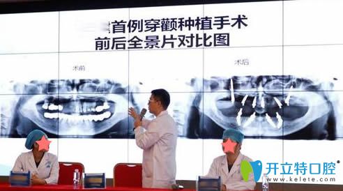 穿顴種植手術(shù)前后全景片對(duì)比圖