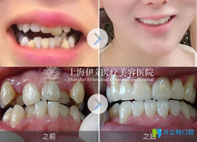 虎牙選擇隱適美隱形矯正前后對(duì)比照