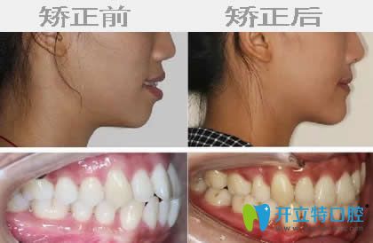 寧波牙博士口腔武文東隱形牙齒矯正案例
