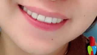 我在臺(tái)州維多利亞戴隱形牙套術(shù)后效果圖