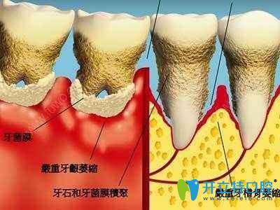 牙齒矯正是否會導致牙齦萎縮