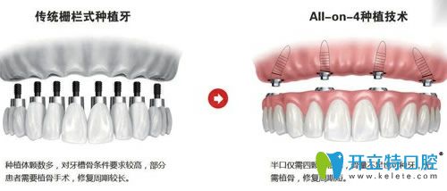 佛山智媄口腔allon4種植牙