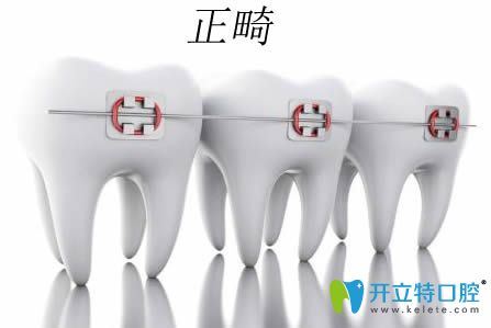 牙齒矯正中常見的10個問題