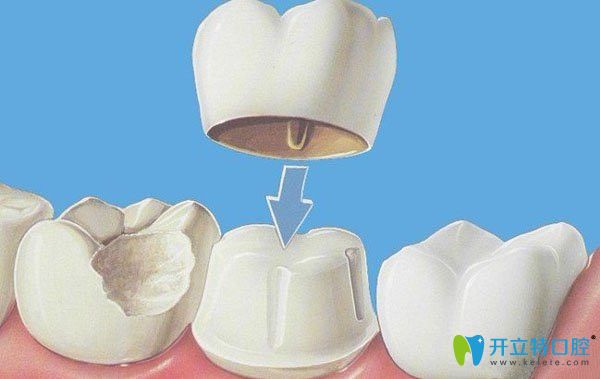 解析美容冠矯正要多久及材料的種類