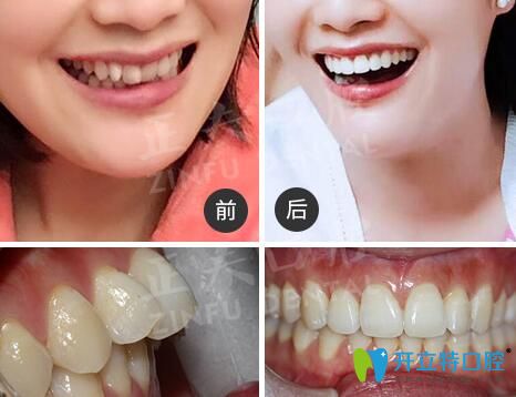 深圳正夫口腔正畸怎么樣？看多組正夫口腔牙齒矯正評(píng)價(jià)