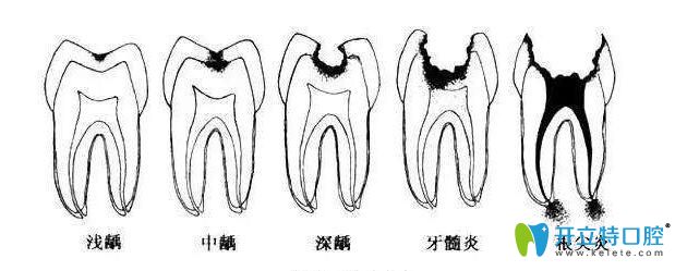 牙齒疼痛不一樣是因為牙壞的程度不一樣
