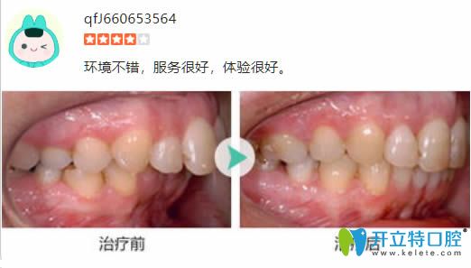 28歲顧客在麗江錦美口腔做完齙牙矯正前后對(duì)比效果