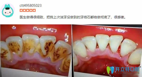 顧客在麗江錦美體驗(yàn)洗牙后前后對(duì)比照