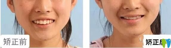 格倫菲爾口腔水平如何？14女孩上牙前突矯正<span style=