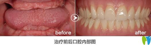 格倫菲爾口腔怎么樣？老年人全口牙缺失種植<span style=
