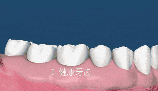 牙齦萎縮后怎么辦