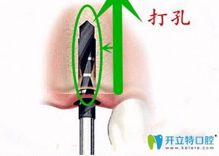 種牙第二步，牙槽骨打孔