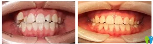 數(shù)字化隱形矯正案例
