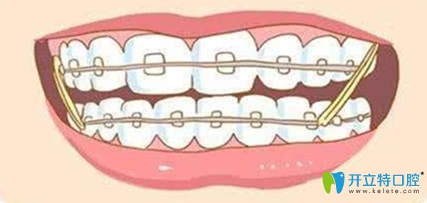 想了解牙齒矯正中橡皮筋的作用/掛多久等等，這里都有哦