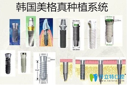 韓國(guó)美格真種植系統(tǒng)