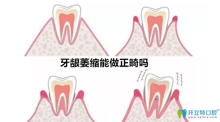 牙齦萎縮能矯正牙么？聽泗洪口腔正畸醫(yī)生解說