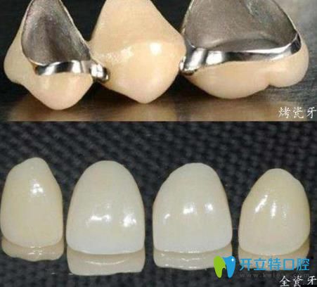 李遷醫(yī)生科普：烤瓷牙和全瓷牙的區(qū)別是什么，哪個好？