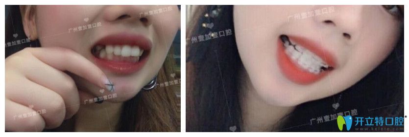 廣州壹加壹齙牙、牙齒擁擠不齊矯正案例效果前后對(duì)比照片