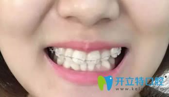 在連江縣明輝口腔做的陶瓷矯正歷經(jīng)18個(gè)月終于要下牙套了！