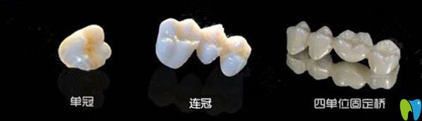 單冠、連冠、四單位固定橋區(qū)別