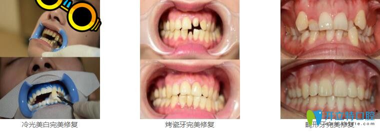 深圳美萊口腔冷光美白+烤瓷牙+瓷貼面修復畸形牙案例