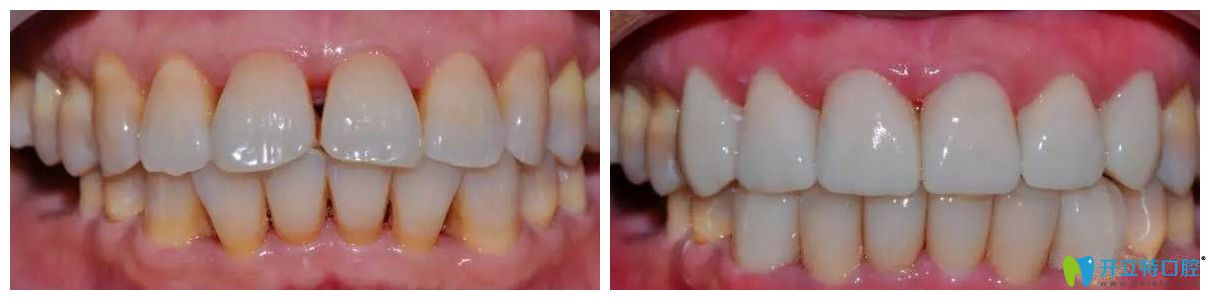 北極星口腔瓷貼面修復(fù)黃牙案例