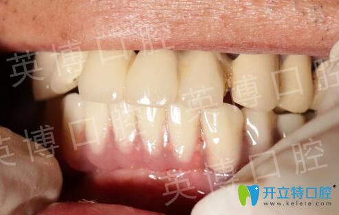 英博口腔下半口牙即刻種植完成效果圖 英博口腔下半口牙即刻種植完成效果圖