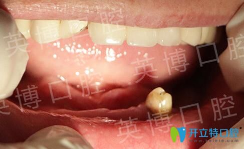 沒有在英博口腔做All-on-4即刻種植牙前 沒有在英博口腔做All-on-4即刻種植牙前