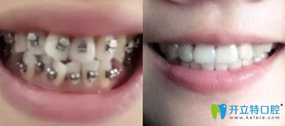 深圳潤(rùn)澤瑞尼絲口腔牙齒矯正效果對(duì)比圖