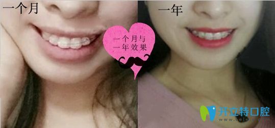 深圳潤澤瑞尼絲口腔矯正一個月和一年效果對比圖