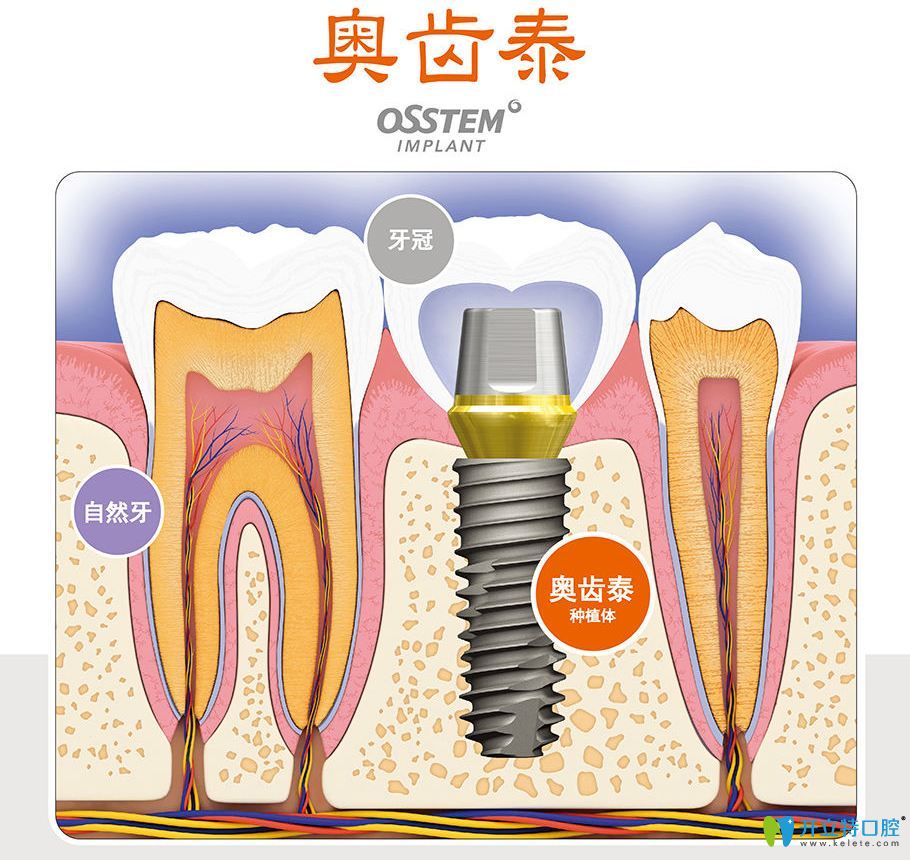 韓國奧齒泰種植牙優(yōu)缺點