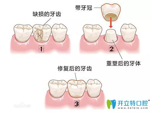 重慶維樂口腔王鳳醫(yī)生介紹全瓷冠修復(fù)優(yōu)勢(shì)