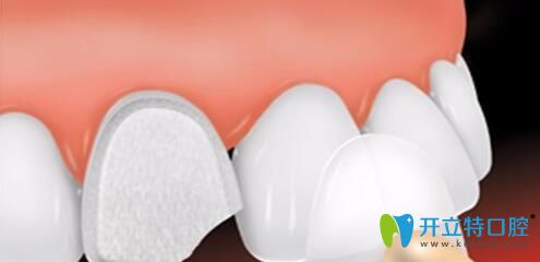 西安藝星口腔陳杰主任科普：做貼面修復是選擇樹脂貼面還是瓷貼面