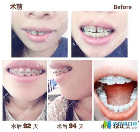 壹加壹齙牙，門牙縫隙矯正過程中牙齒變化圖