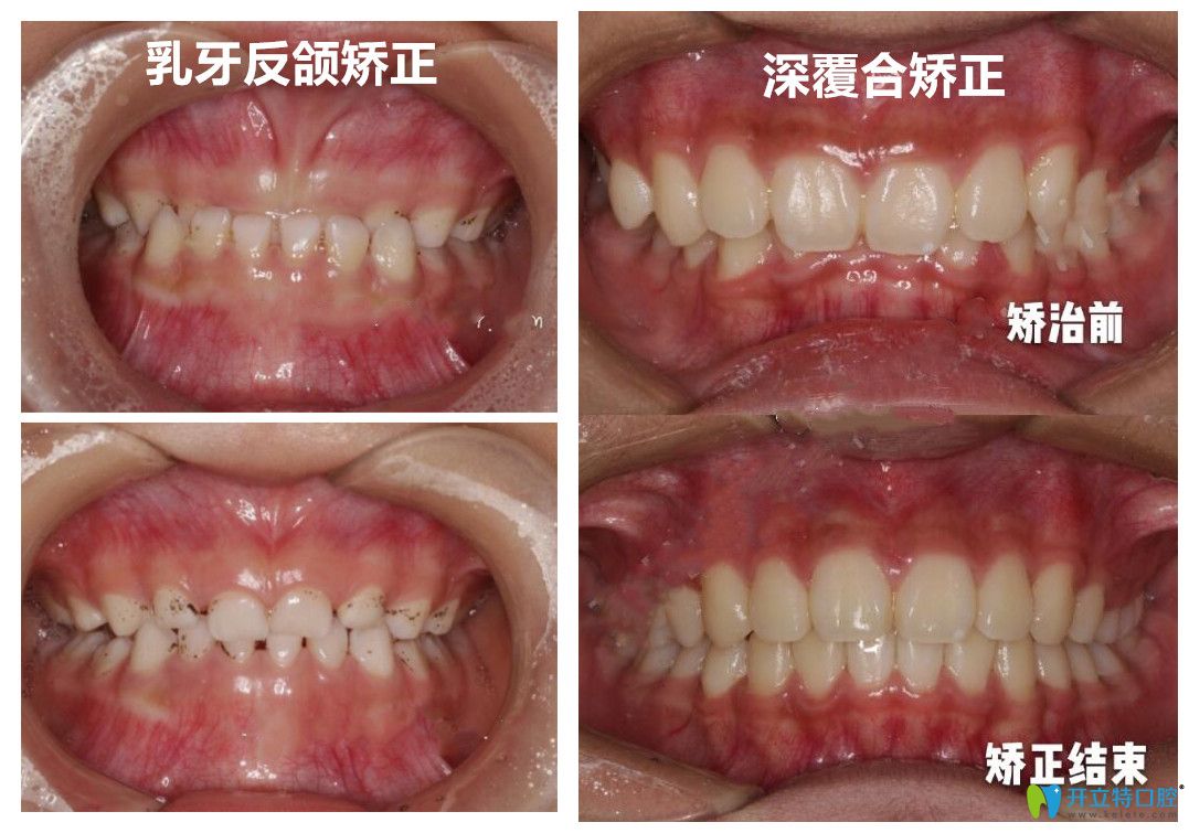 深圳美萊口腔韓旭醫(yī)生做牙齒矯正怎么樣？有案例為證哦