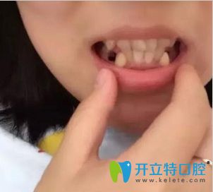 順德矯正牙齒哪個醫(yī)院好呢?壹加壹口腔齙牙正畸效果供參考