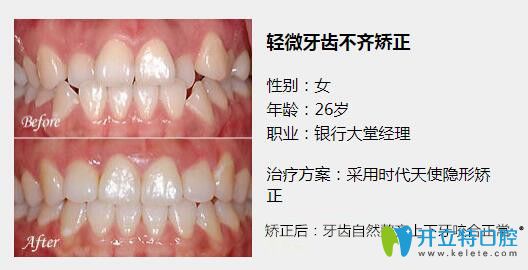 惠州致美口腔時代天使隱形矯正案例