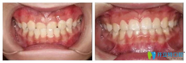 青島維樂口腔地包天矯正