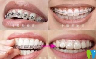 昆明尚愛韓美口腔許敬醫(yī)生分享做牙齒矯正期間的注意事項(xiàng)