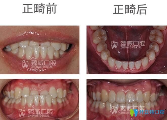 小姐姐矯正地包天后不僅牙齒變整齊了，臉型也有了很大的改變