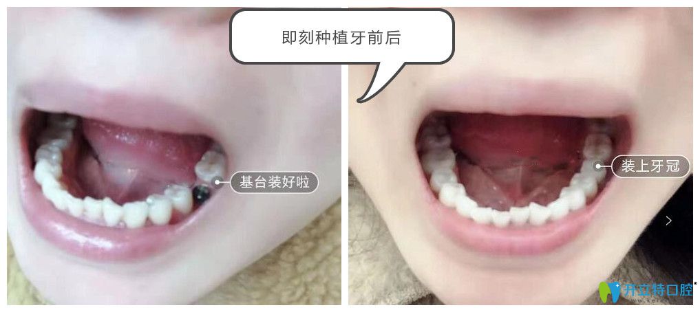 <!--<i data=20240703-sp></i>-->英博口腔翁弘元給我做單顆種植牙效果 <!--<i data=20240703-sp></i>-->英博口腔翁弘元給我做單顆種植牙效果