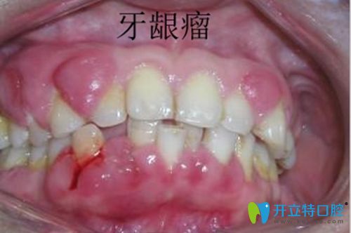 好怕怕!妊娠期牙齦瘤怎么控制?是不是腫瘤？