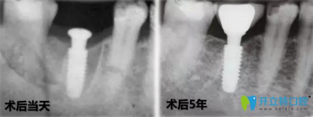 法國安卓健種植牙穩(wěn)定性強(qiáng)